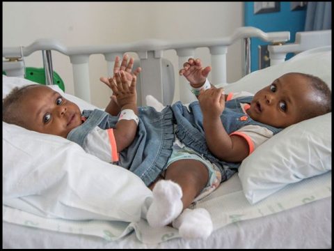 MEMPHIS CHILDREN'S HOSPITAL SUCCESSFULLY SEPARATES CONJOINED TWINS